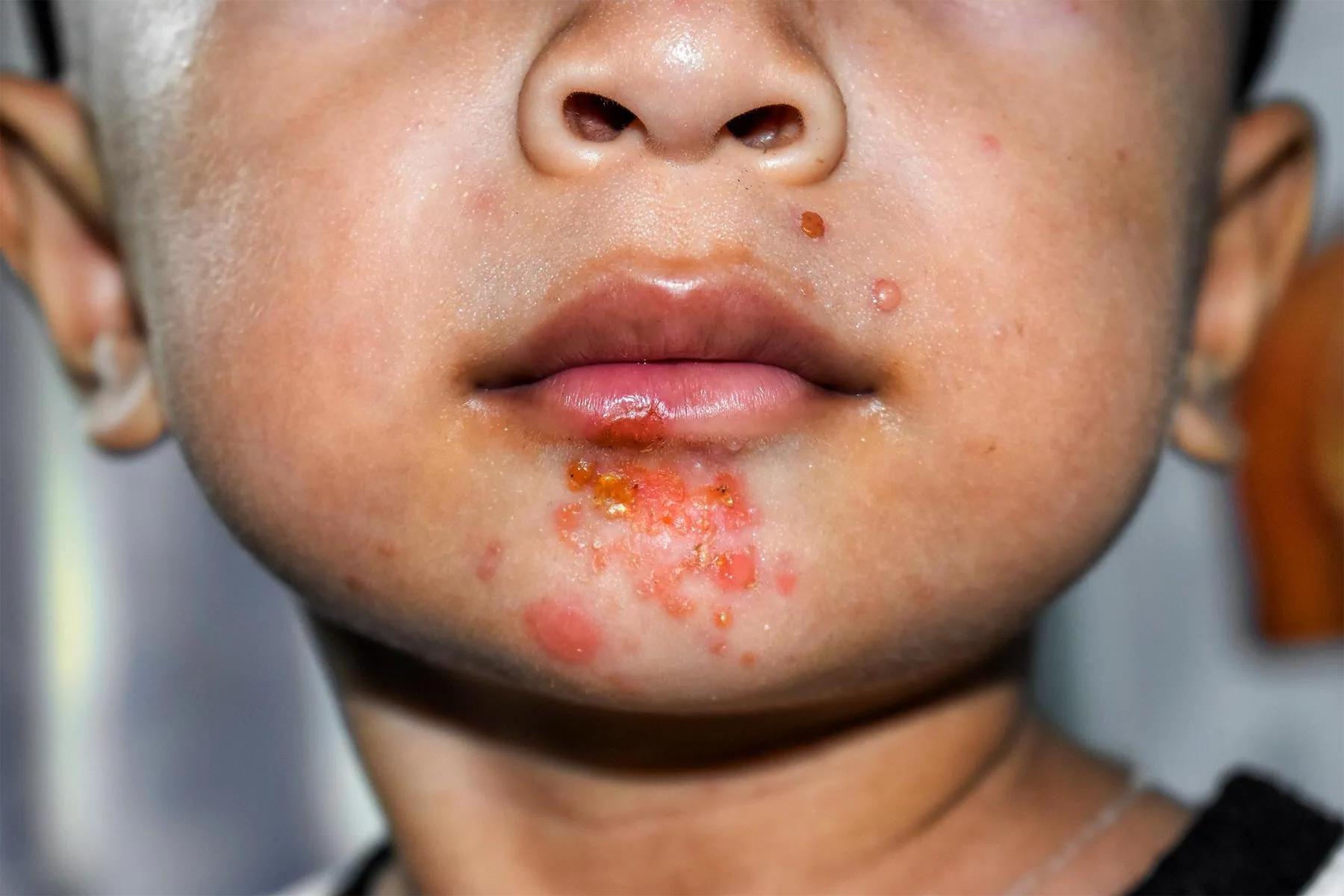 26 Fakta Tentang Impetigo