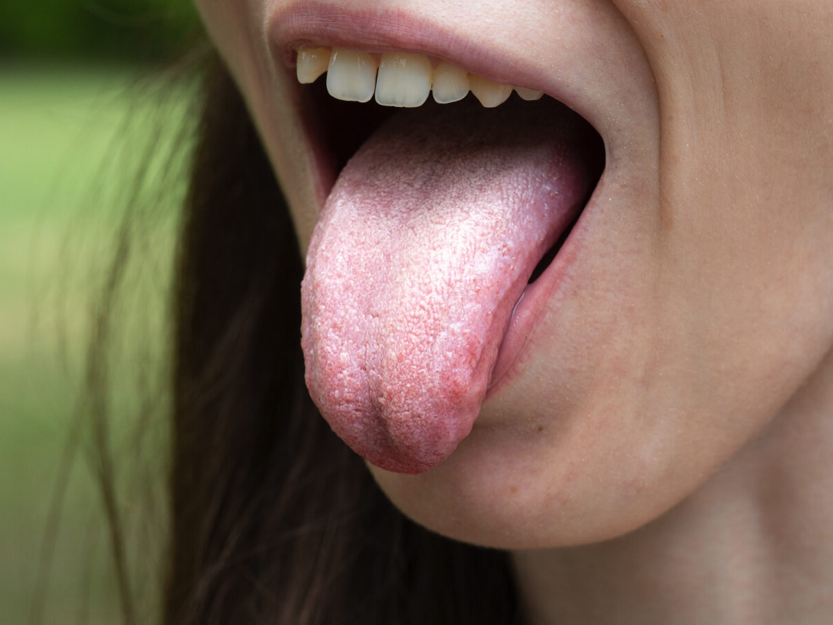 30 Fakta Tentang Xerostomia