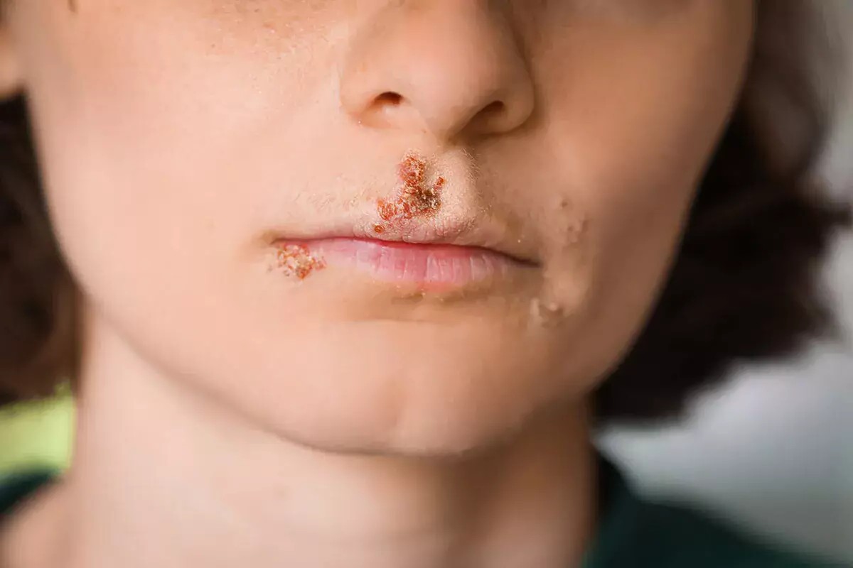 32 Fakta Tentang Stomatitis