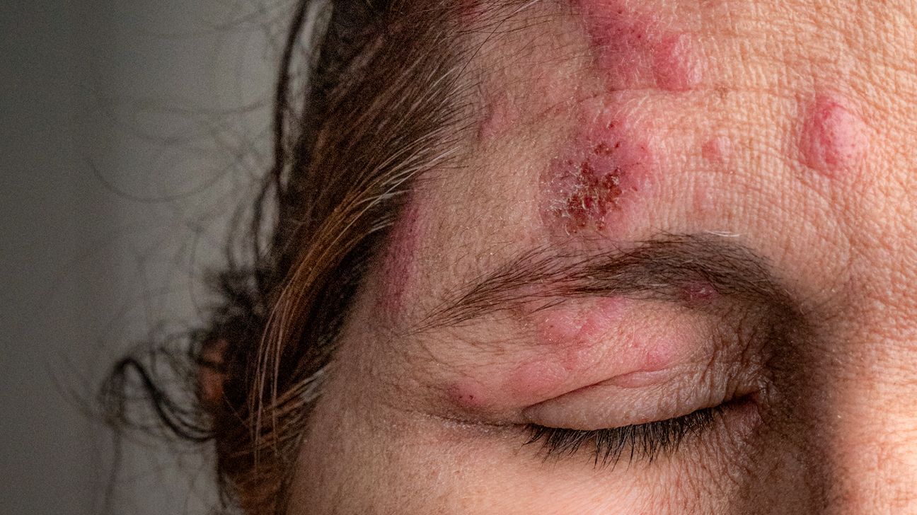 37 Fakta Tentang Herpes Zoster